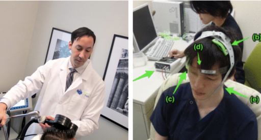 Knowing The Difference Between rTMS and tDCS