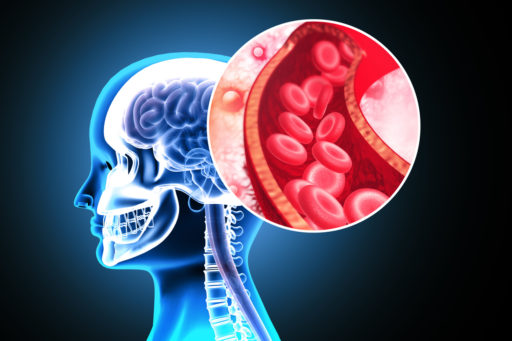 Different Strokes: How to Treat Post-Stroke Depression