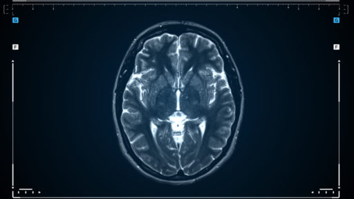 What Does TMS Target in the Brain?